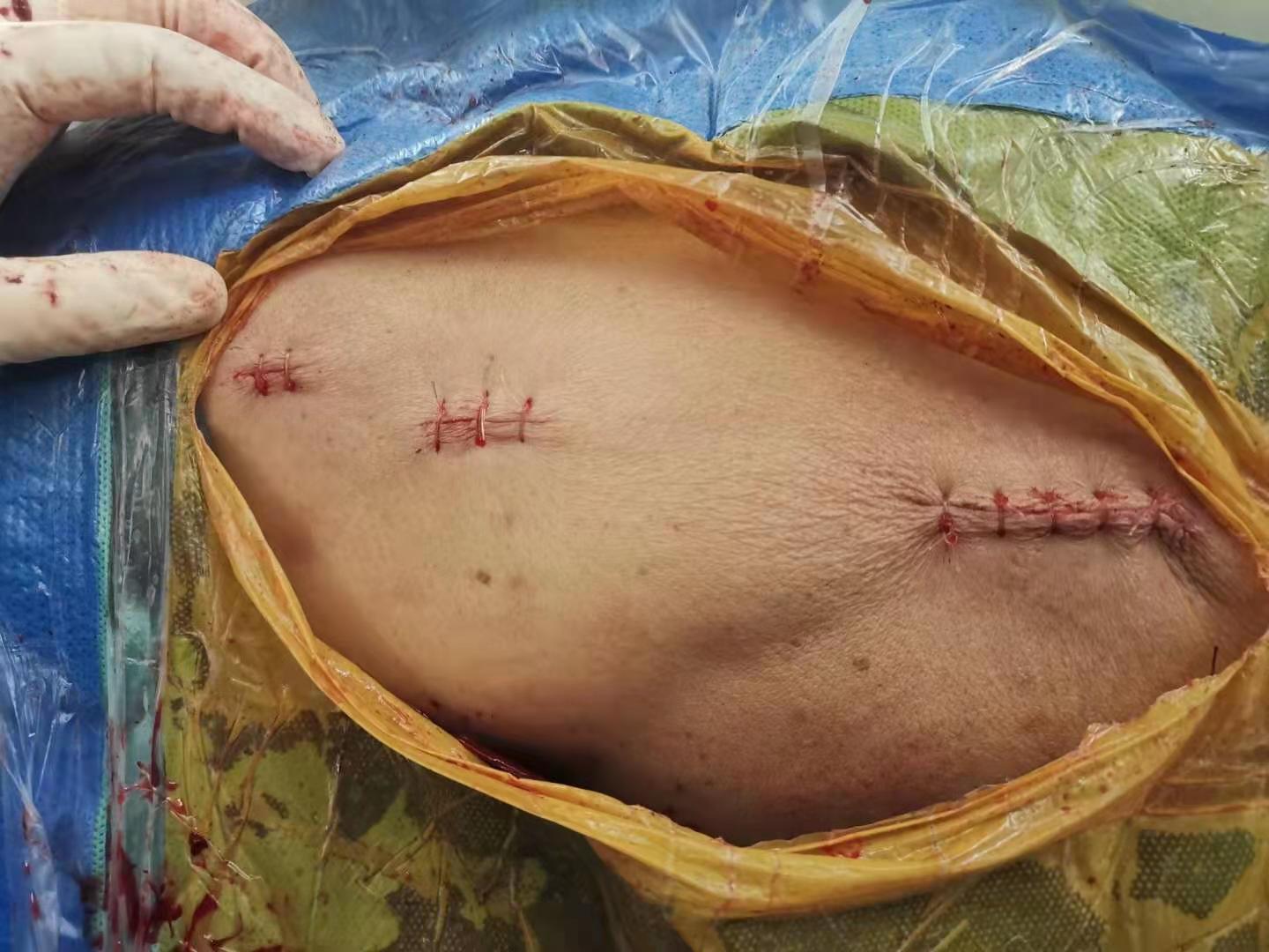 肺结节手术后需要拆线吗,腰椎手术后几天拆线最好