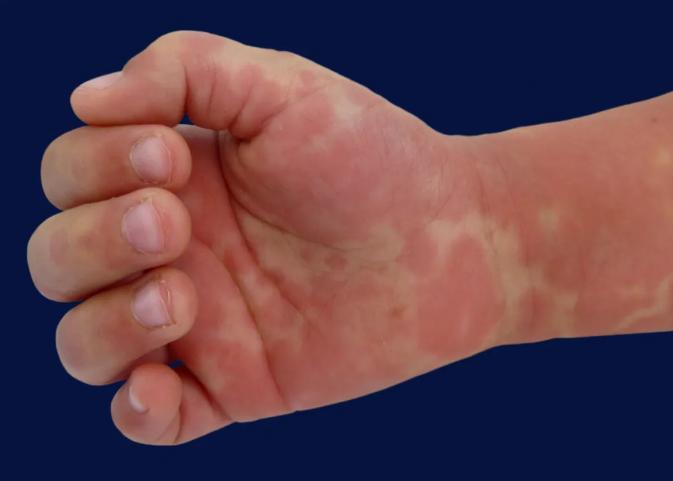 哪些国家有儿童感染新冠病毒的,现在新冠病毒儿童最新症状