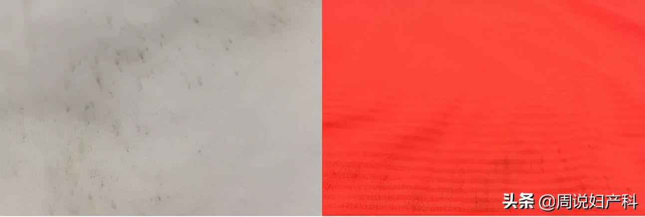 *裤内**长霉点还能穿吗?女性更要注意