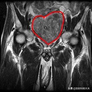 脑出血几年以后复发,脑出血几年后偏瘫越来越严重