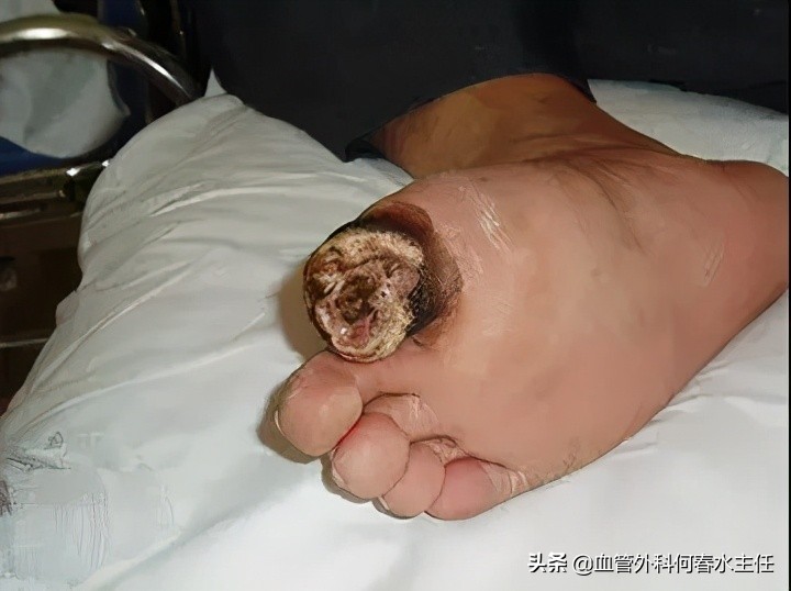 静脉曲张腿脚不好？治疗有“门路”