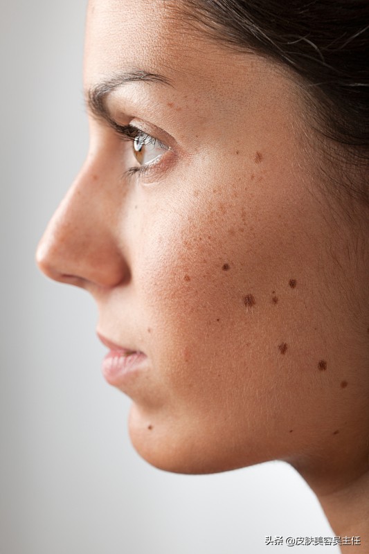 激光祛斑后不红不肿不痛咋回事,激光祛斑没有结痂反而更黑