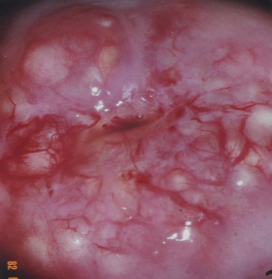 宫颈炎到底要不要治疗？