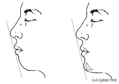 下巴后缩怎么拍侧颜,下巴后缩需要怎么矫正