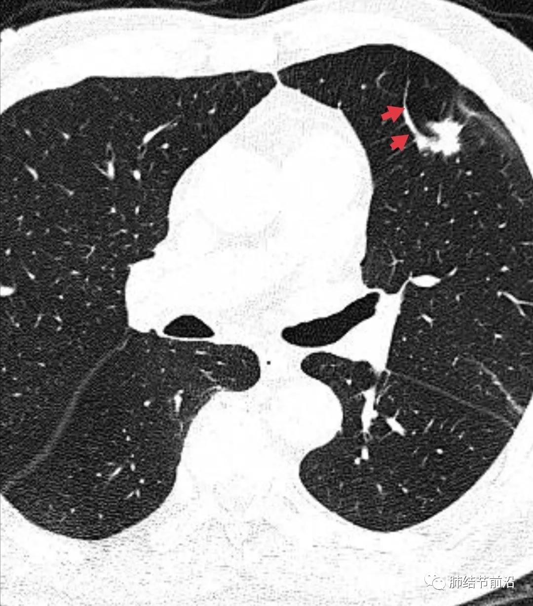 肺部ct肺结节读片教学视频,肺结节读片的专业术语