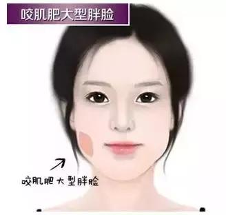 瘦脸针的5个常见问题,瘦脸针其实副作用挺大的