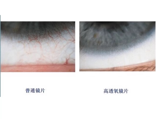 隐形眼镜三无产品,隐形眼镜买来三天裂了