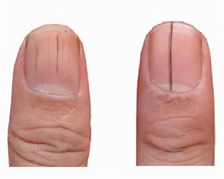 指甲上出现竖纹是身体出现了状况,如果指甲上有竖纹要注意了