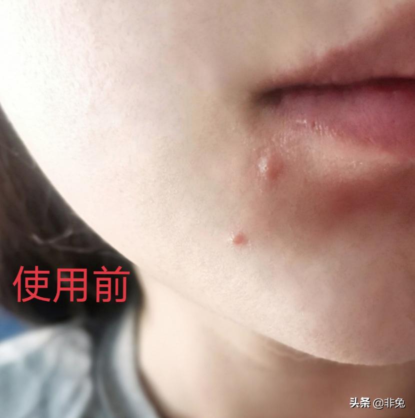 祛痘仪测评真实推荐,祛痘实测