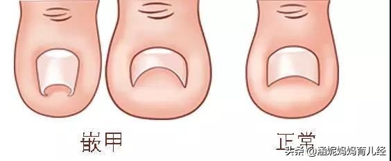孩子脚趾边疼是甲沟炎吗,孩子脚趾指甲盖突然疼痛