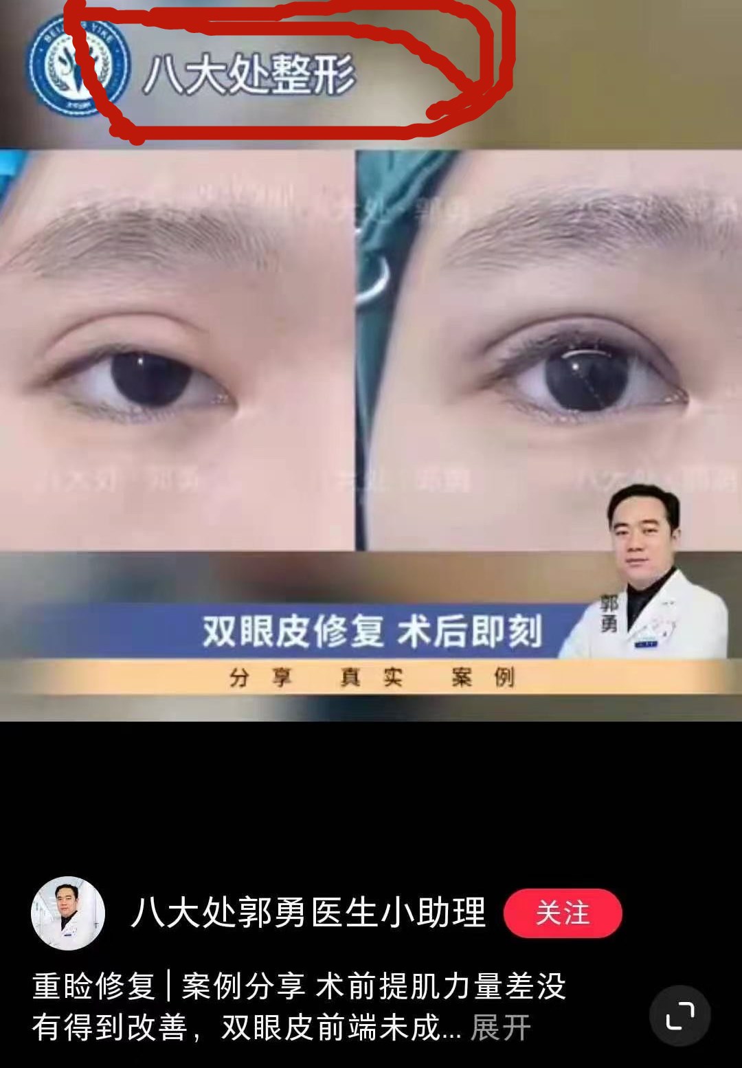 单眼上睑下垂修复术,上睑下垂眼睛修复手术成功率高吗