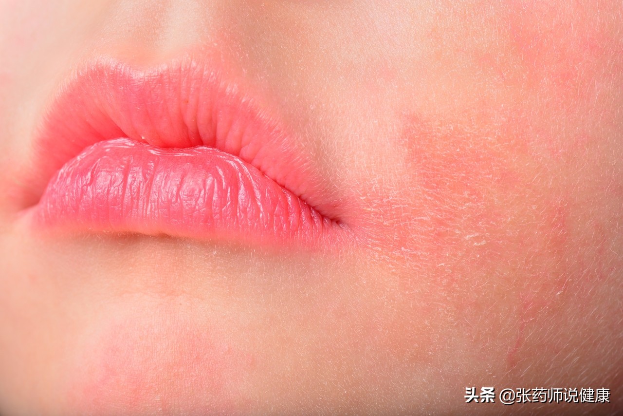 冬季湿疹反复瘙痒,湿疹反复皮肤瘙痒应吃什么药