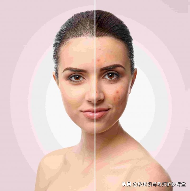 额头脸颊下巴长痘怎么调理,额头脸颊下巴反复长痘如何调理