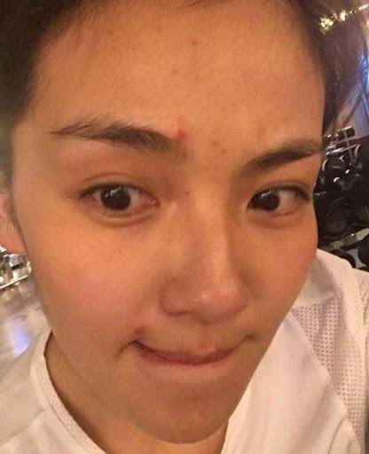 痘痘痘印的正确处理方法,痘痘留下的痘印应如何正确处理