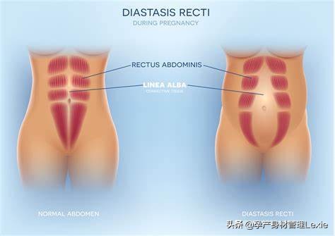 产后瘦身找对方法很重要——6个动作帮你恢复腹直肌分离