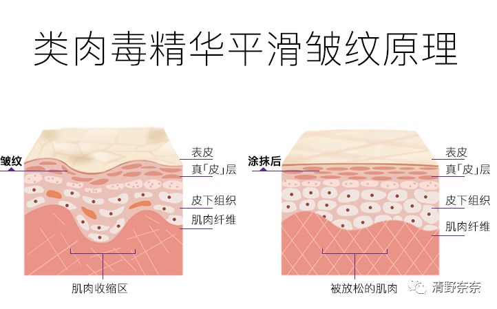 四十岁有法令纹川字纹医美项目,法令纹和鱼尾纹用医美怎么处理