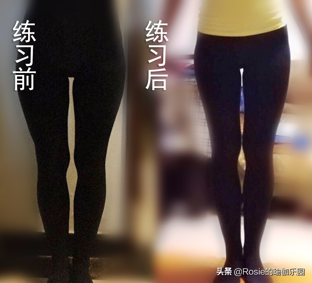 大腿外侧肉肉突出怎么减,改善大腿外侧外翻的方法