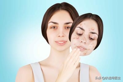 脸上痘痘好了痘印怎么祛除,男孩脸上痘印怎么祛除最快