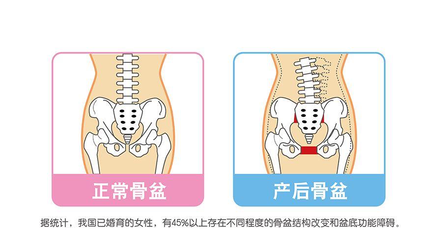 产后修复原来有这么多疑问,产后修复你了解多少
