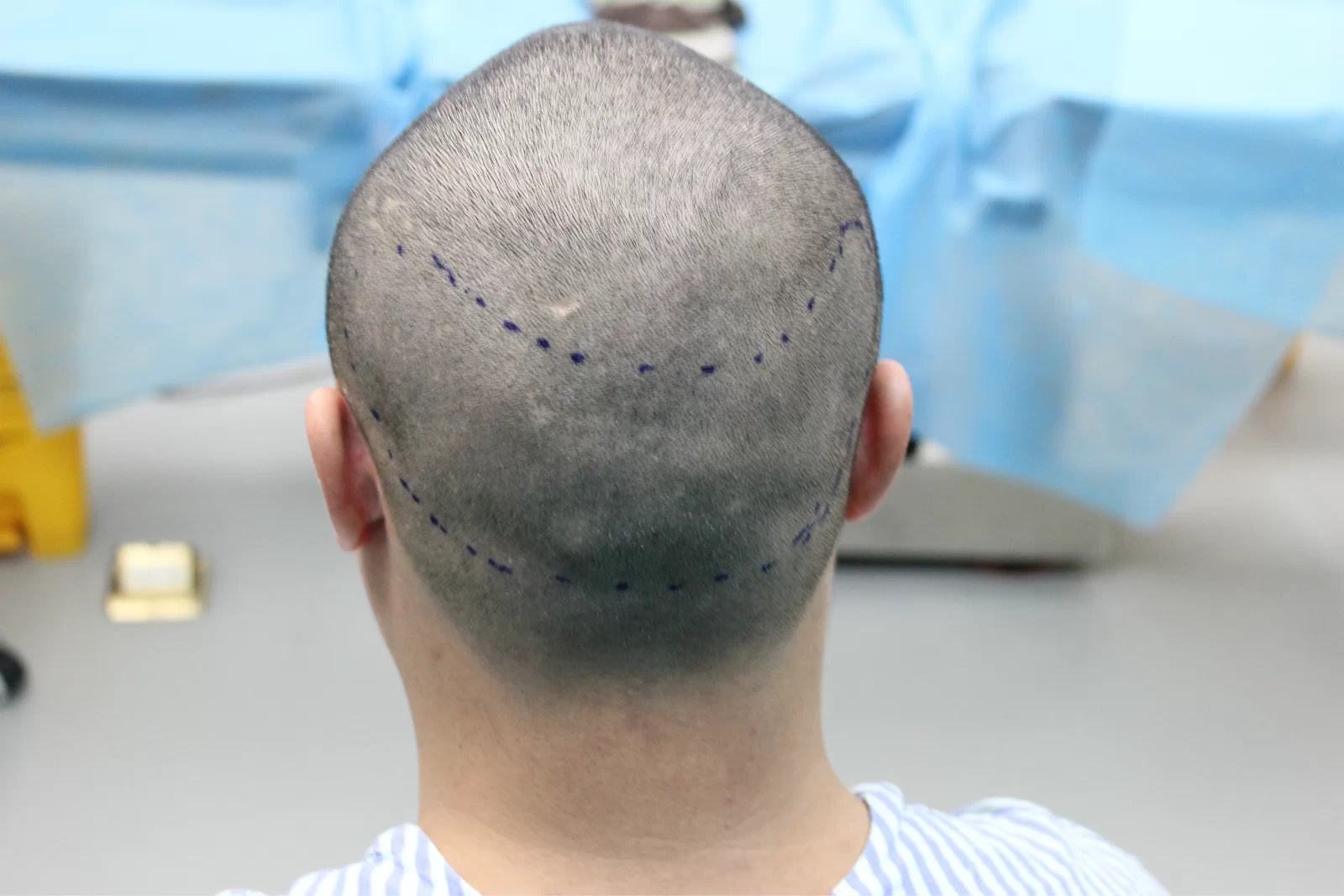 造成脱发真正的原因是什么,常见的引起脱发的原因有哪些