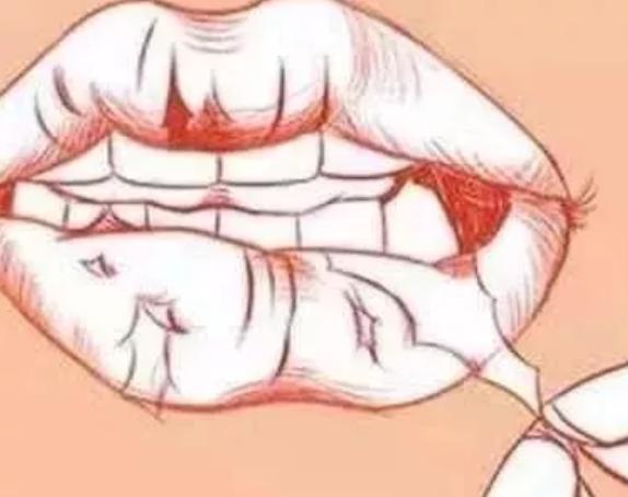 嘴唇干裂舔发白了怎么办,嘴唇干裂起皮又疼又痒怎么办