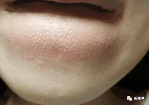 鼻翼凸起的白色小肉粒怎么去除,下巴和鼻子的小颗粒怎么去除
