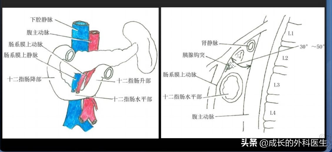 肠系膜上动脉压迫综合征ct表现,儿童肠系膜压迫综合征哪种手术好