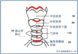 干货：气管切开术及护理措施
