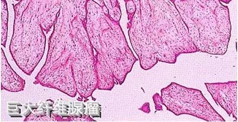 什么是乳腺纤维腺瘤？摸到乳房上有肿块，还不痛，就要小心了