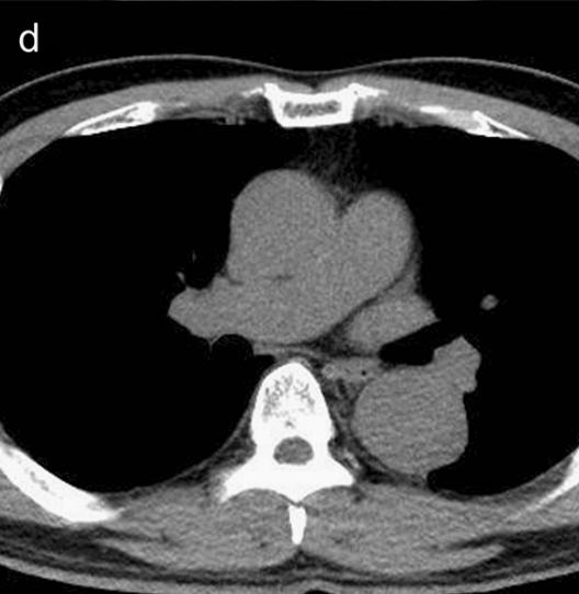 如何监测动脉夹层早期,动脉增强ct能查出主动脉夹层么