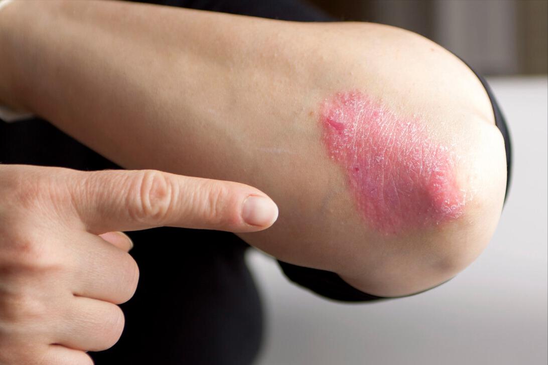 身上出现白斑是癌症吗,身上出现白斑都是白癜风吗