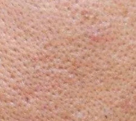 苨萃（NICUI）护肤：有哪些医美手段可以真正收缩毛孔？