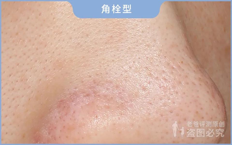 黑头怎么从根部去除,黑头到底怎么去