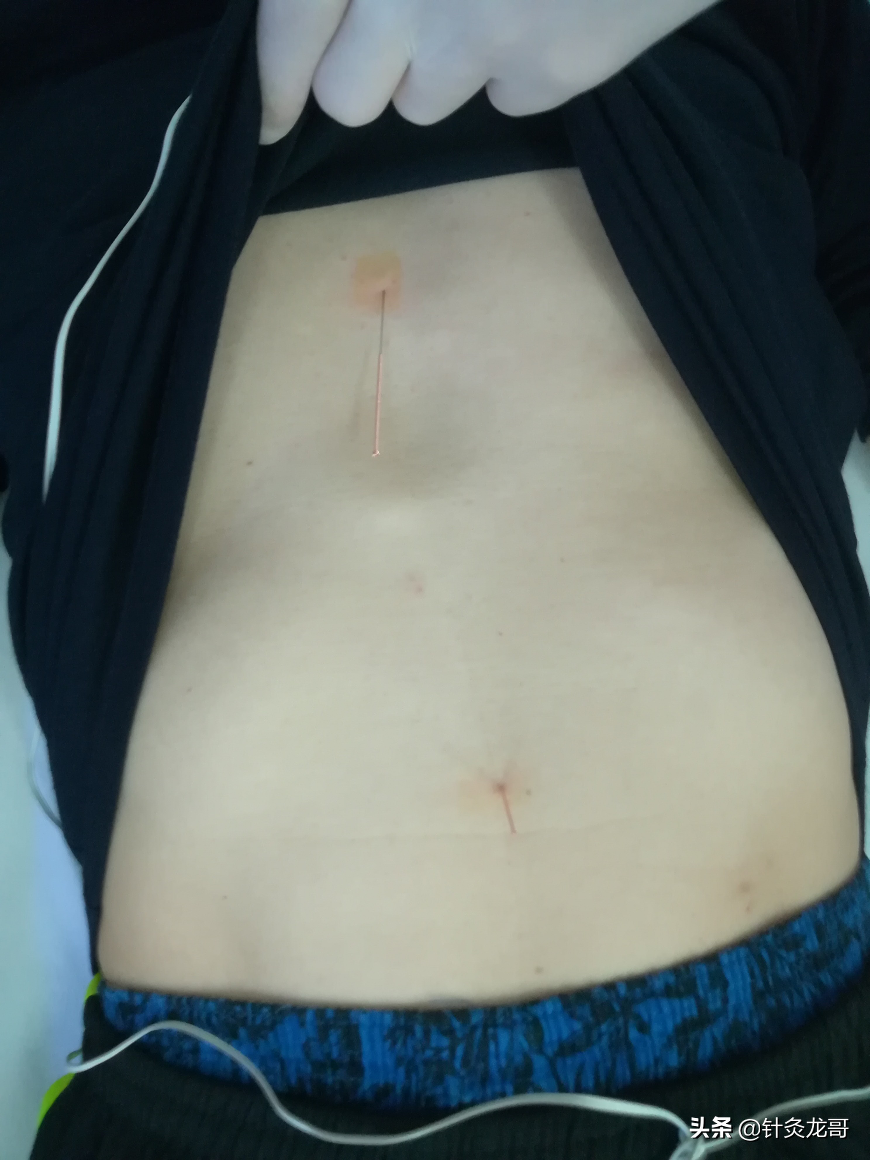 咽喉有异物怎么检查一下,咽喉有异物感好几个月了