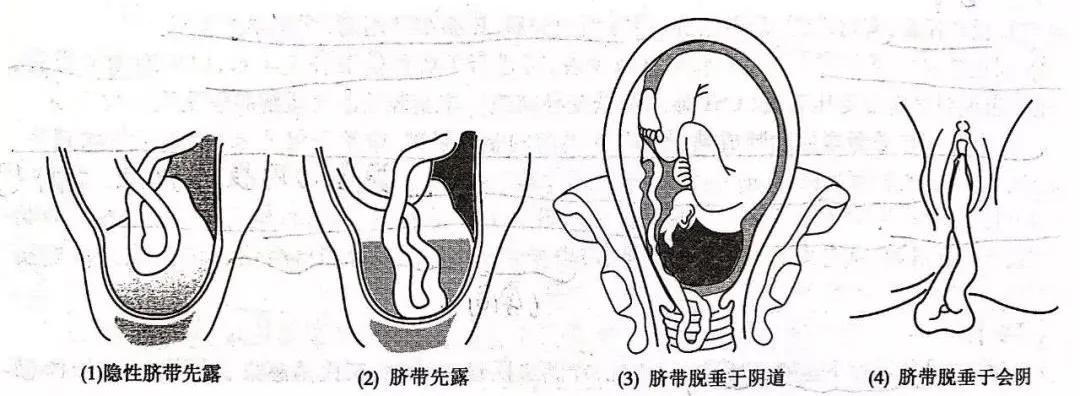 脐带脱落胎儿命悬一线,婴儿出生十天脐带未脱落且有血