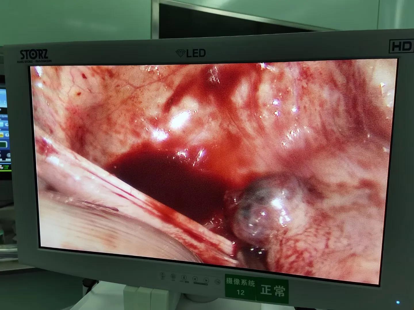 人流术后半月，突然剧烈腹痛…