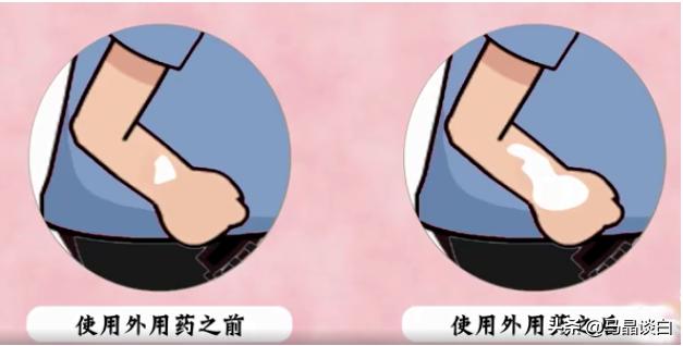 白癜风涂抹外用药危害的视频,白癜风的外用药会伤肝肾吗
