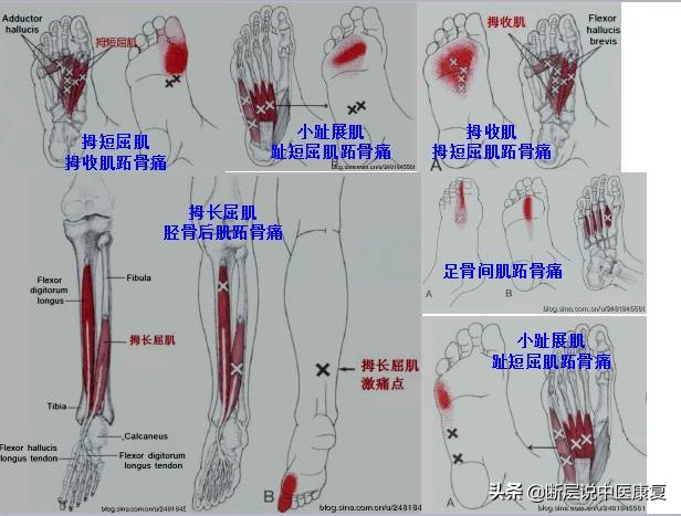 激痛点挂图,激痛点疗法笔记