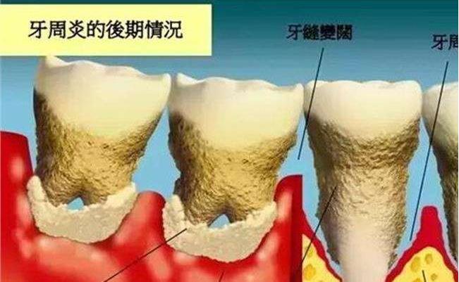 牙龈萎缩造成牙齿很松需要拔掉吗,牙龈萎缩严重导致牙齿掉