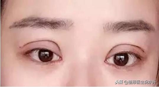 割双眼皮后怎样可以尽快完全恢复,割的双眼皮很不自然要怎么修复呢