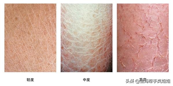 入秋宝宝皮肤突然干燥泛红有疙瘩,小孩手痒脱皮的原因和治疗方法
