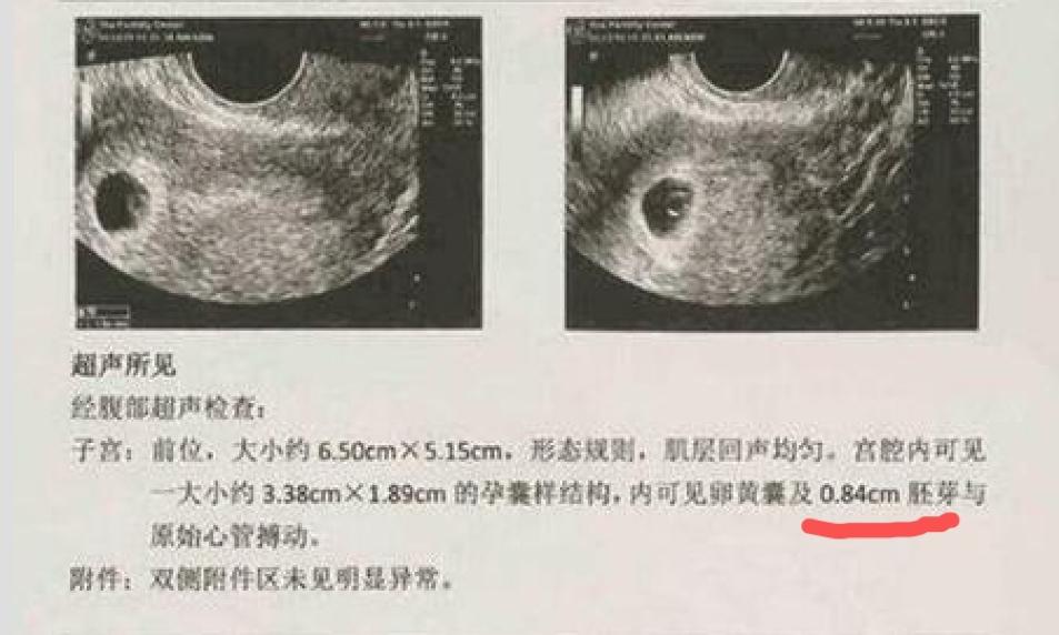 早孕试纸怎么看出怀孕了,早孕期间怎么确定怀孕几周了