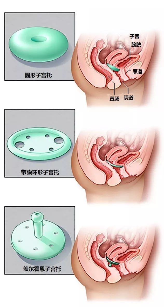 盆底肌松弛漏尿膨出最佳治疗方法,产后10年漏尿盆底肌康复