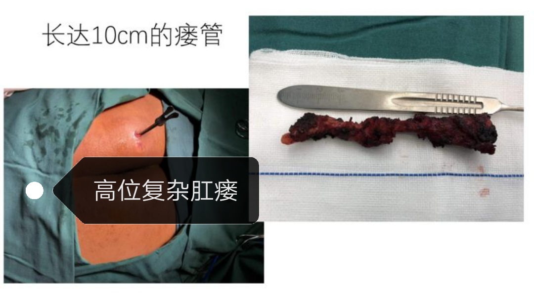 肛瘘手术切口肉挖空了怎么回事,肛瘘手术当天要不要人照顾