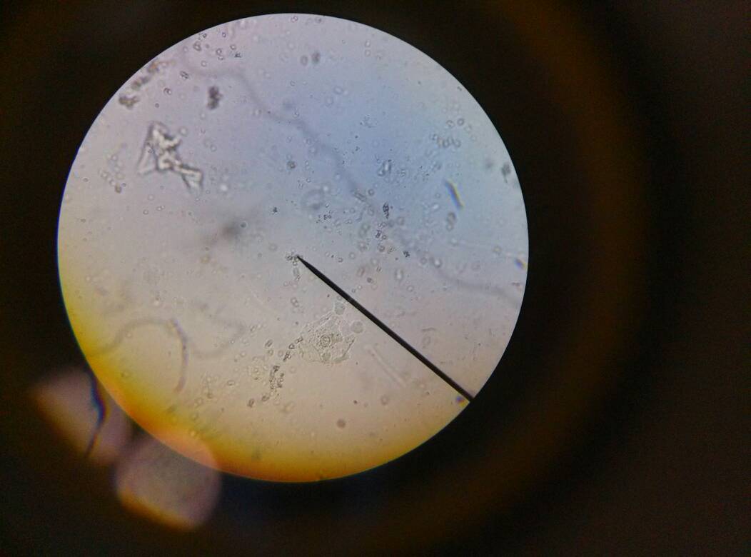 小儿李斯特菌病，常见于新生儿，以及有免疫缺陷的儿童，成人少见