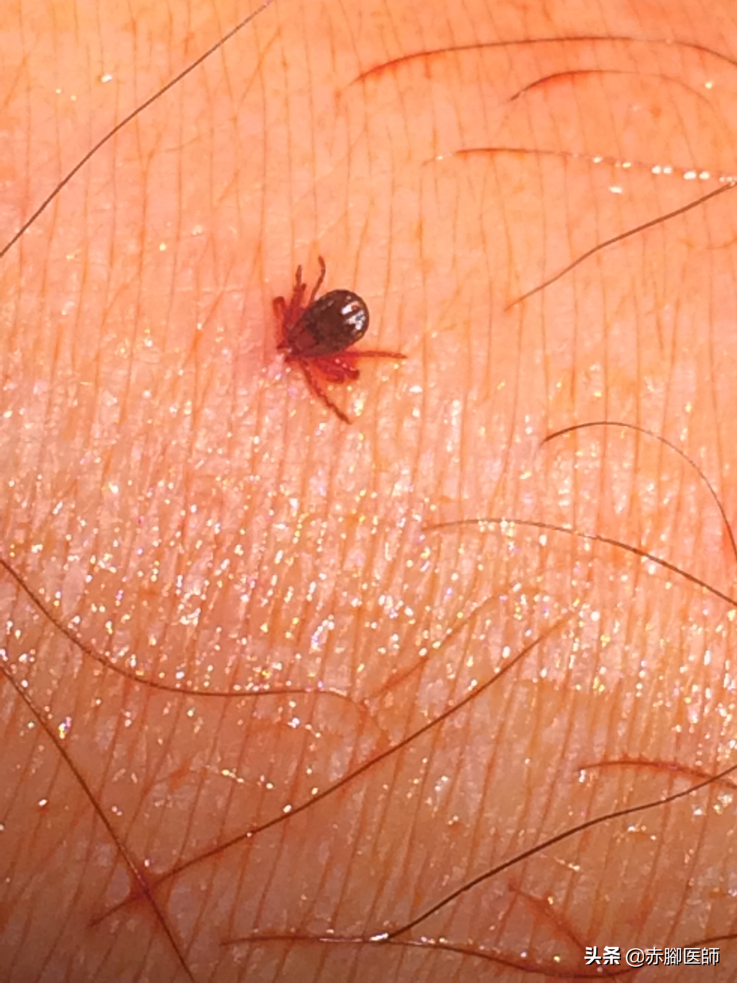 蜱虫叮咬后正确处理方法,蜱虫长期叮咬在人身上会怎样