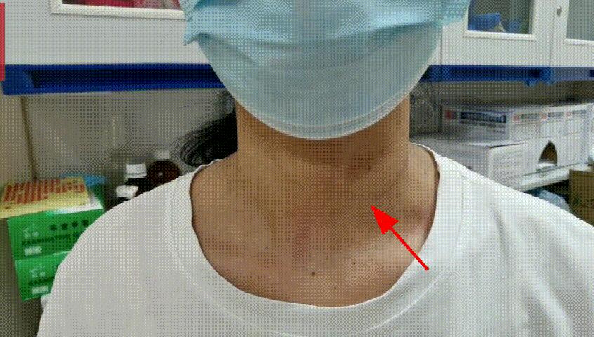 甲状腺结节微创消融手术,甲状腺结节微创消融医保