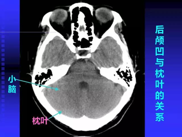 头颅mri读片视频教程,颅脑mri读片入门教程视频讲解全集