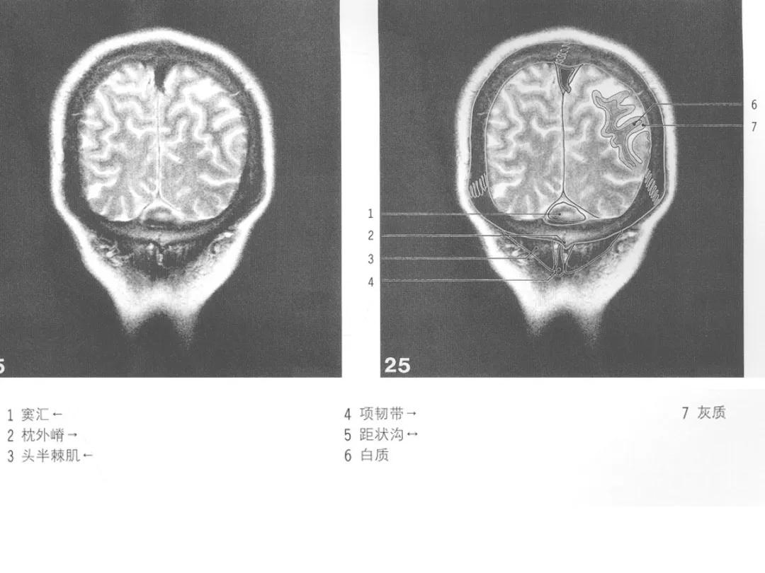 颅脑冠状状切面解剖图,颅脑mr解剖结构图