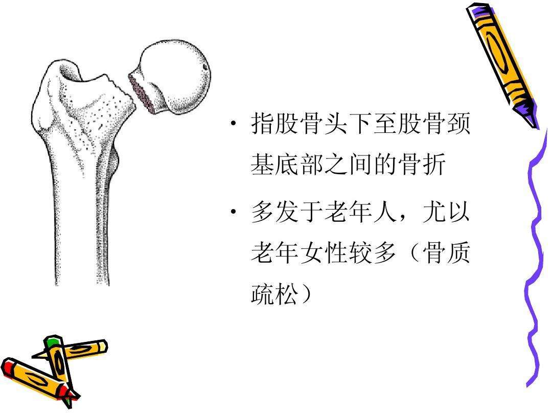 老年人股骨颈骨折建议,80岁老年人股骨颈骨折保守治疗